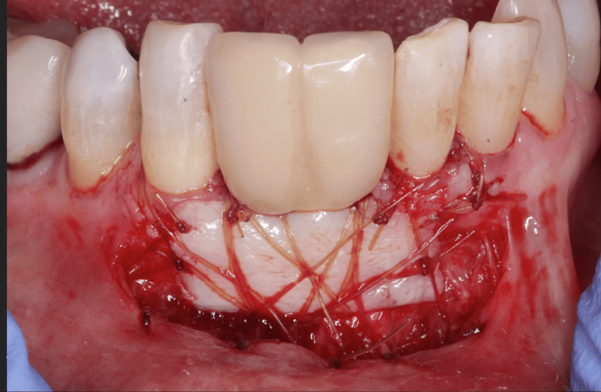 Autogenous Free Gingival Graft to Increase Keratinized Tissue around Dental Implants