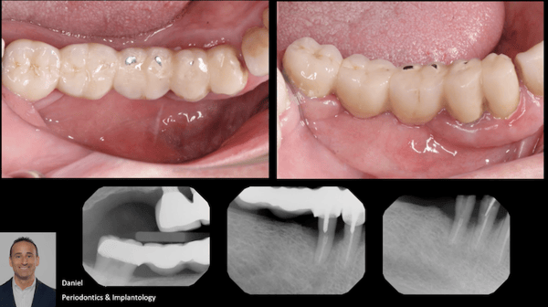 Bone Regeneration of Extensive Socket Defects with Immediate Implant Placement 1