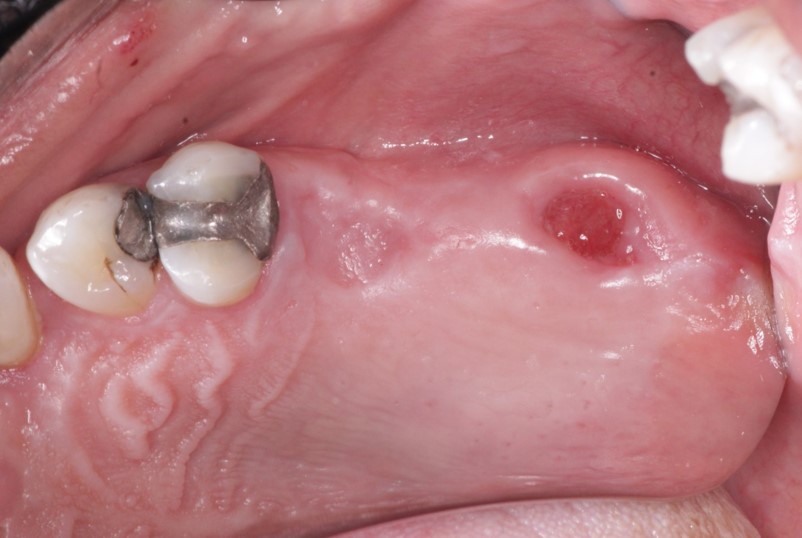 Addressing an Oral-Antral Communication