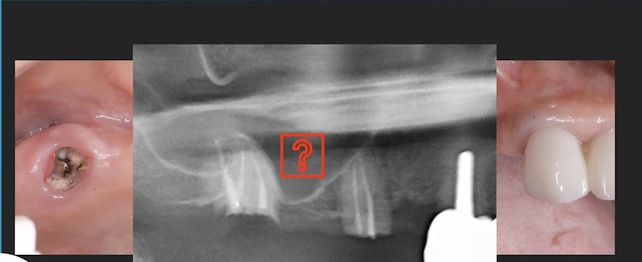 An Alternative to a Lateral Sinus Augmentation