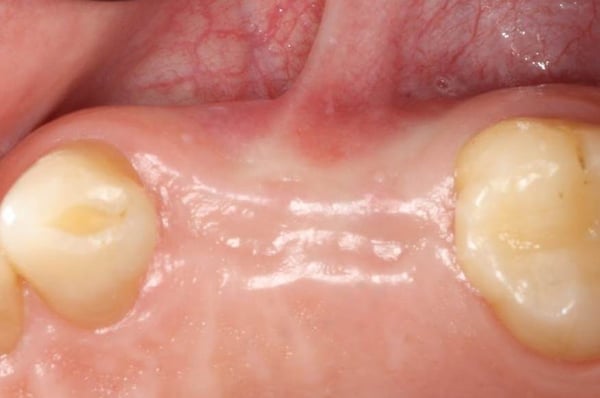 Immediate Implant Placement with Modified Palatal Roll 3