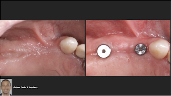 Implant Uncovery Technique to Maximize Ridge Augmentation 3