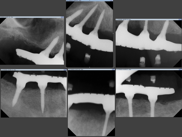Miniature Implants to Restore a Full Arch 7