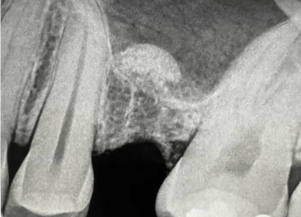 Intra-Crestal Sinus Lift and Bone Augmentation 1