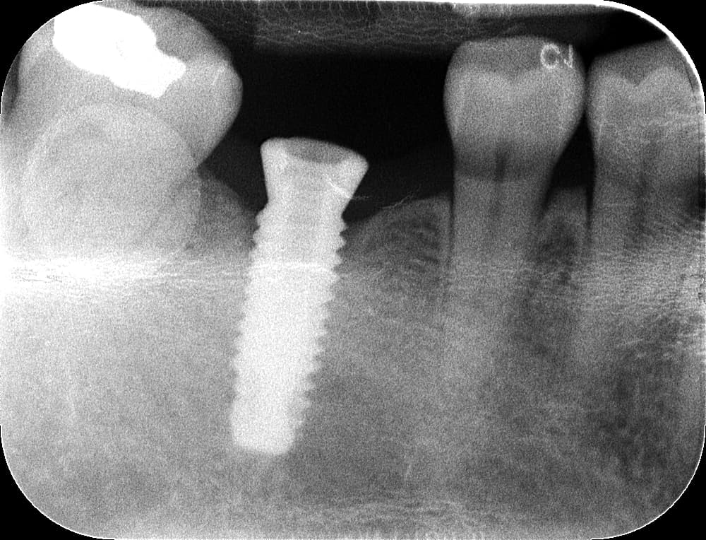 I need help identifying this implant