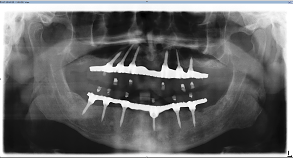 Miniature Implants to Restore a Full Arch 5