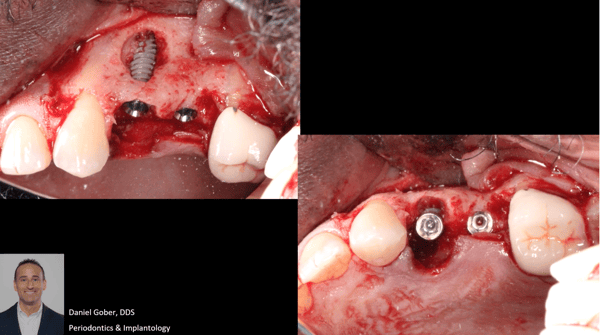 Trusting the Process: Removal of Odontoma, GBR, and Placement of Keystone Paltop Implants 2