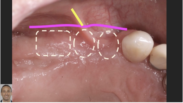 Implant Uncovery Technique to Maximize Ridge Augmentation 2