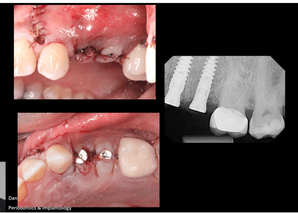 Trusting the Process: Removal of Odontoma, GBR, and Placement of Keystone Paltop Implants 5