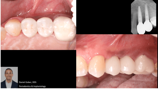 Trusting the Process: Removal of Odontoma, GBR, and Placement of Keystone Paltop Implants 6