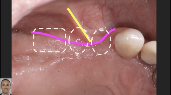 Implant Uncovery Technique to Maximize Ridge Augmentation