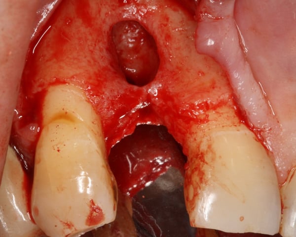 The Management of a Hopeless Maxillary Anterior Tooth: Part I 3