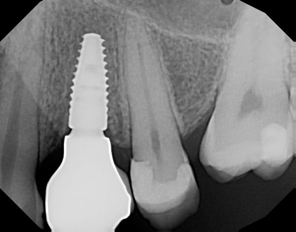 How to restore subcrestal implants? 1