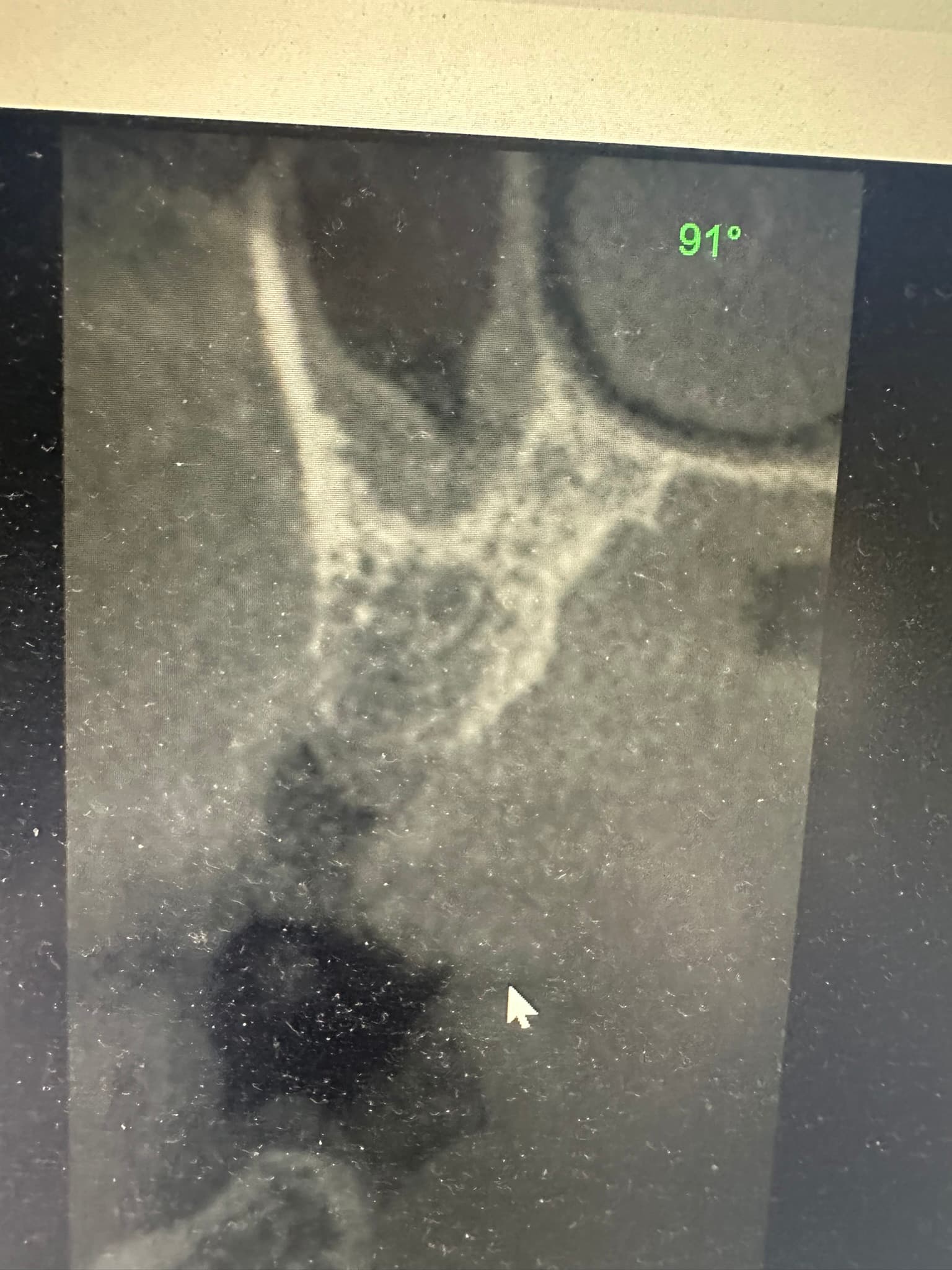 Would you preform a sinus lift if the thickening of sinus membrane is as shown in this case?
