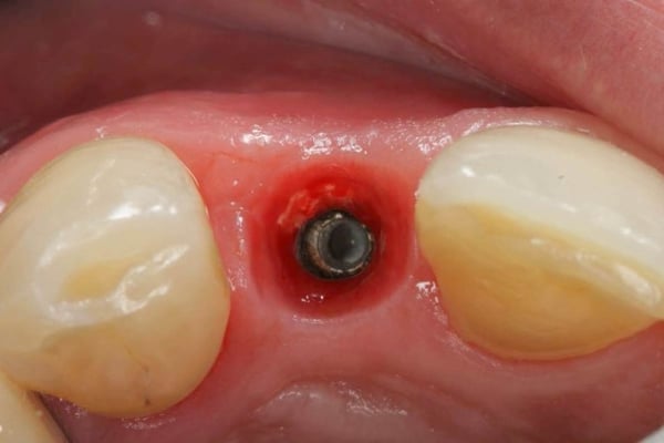 The Management of a Hopeless Maxillary Anterior Tooth Part II: Implant Placement and Restoration 3