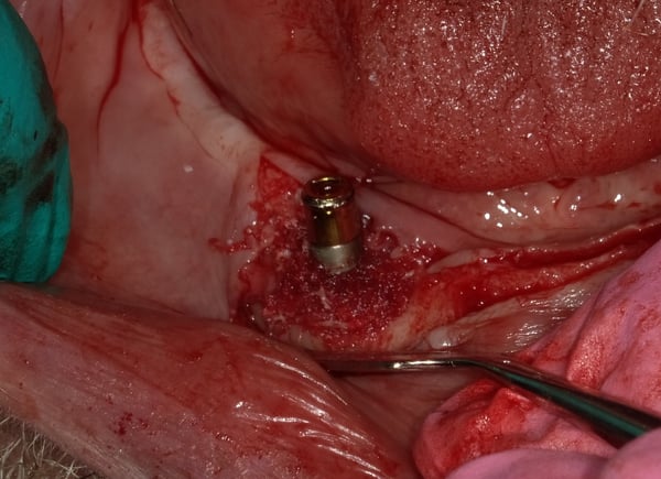 How do you treat Peri-Implantitis? 6