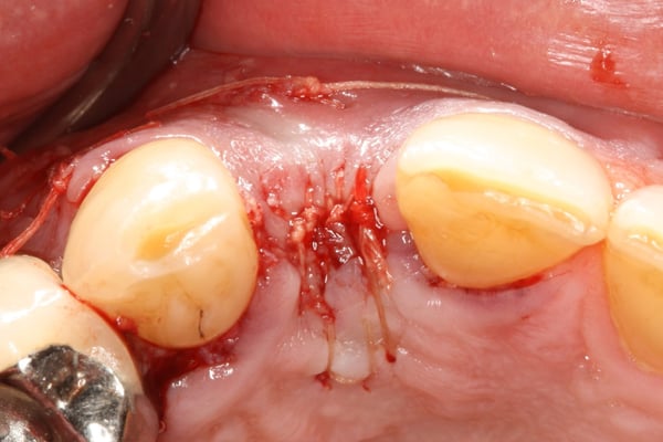 The Management of a Hopeless Maxillary Anterior Tooth: Part I 4