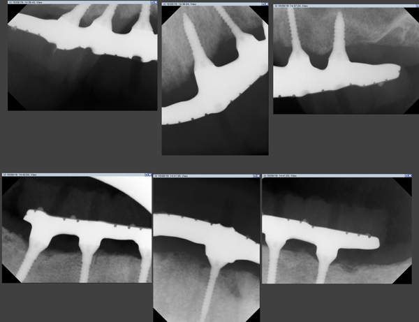 Miniature Implants to Restore a Full Arch 6