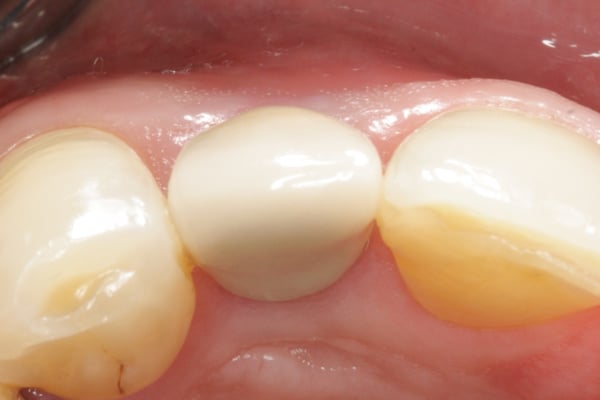 The Management of a Hopeless Maxillary Anterior Tooth Part II: Implant Placement and Restoration 5