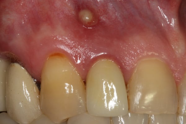 The Management of a Hopeless Maxillary Anterior Tooth: Part I 1