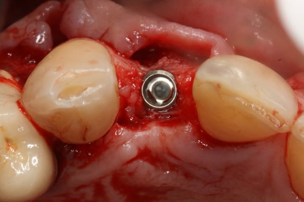 The Management of a Hopeless Maxillary Anterior Tooth Part II: Implant Placement and Restoration 2