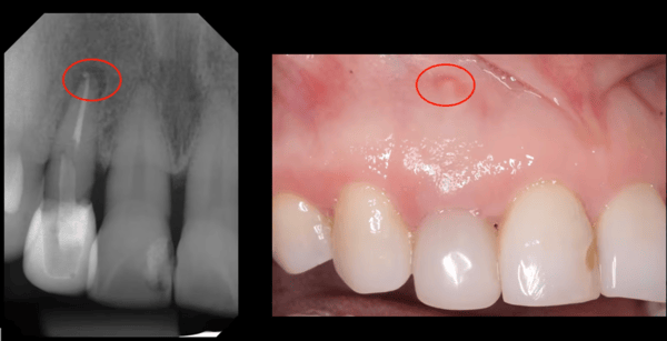 Regenerating Fenestration Defects during Extraction and Implant Placement 1