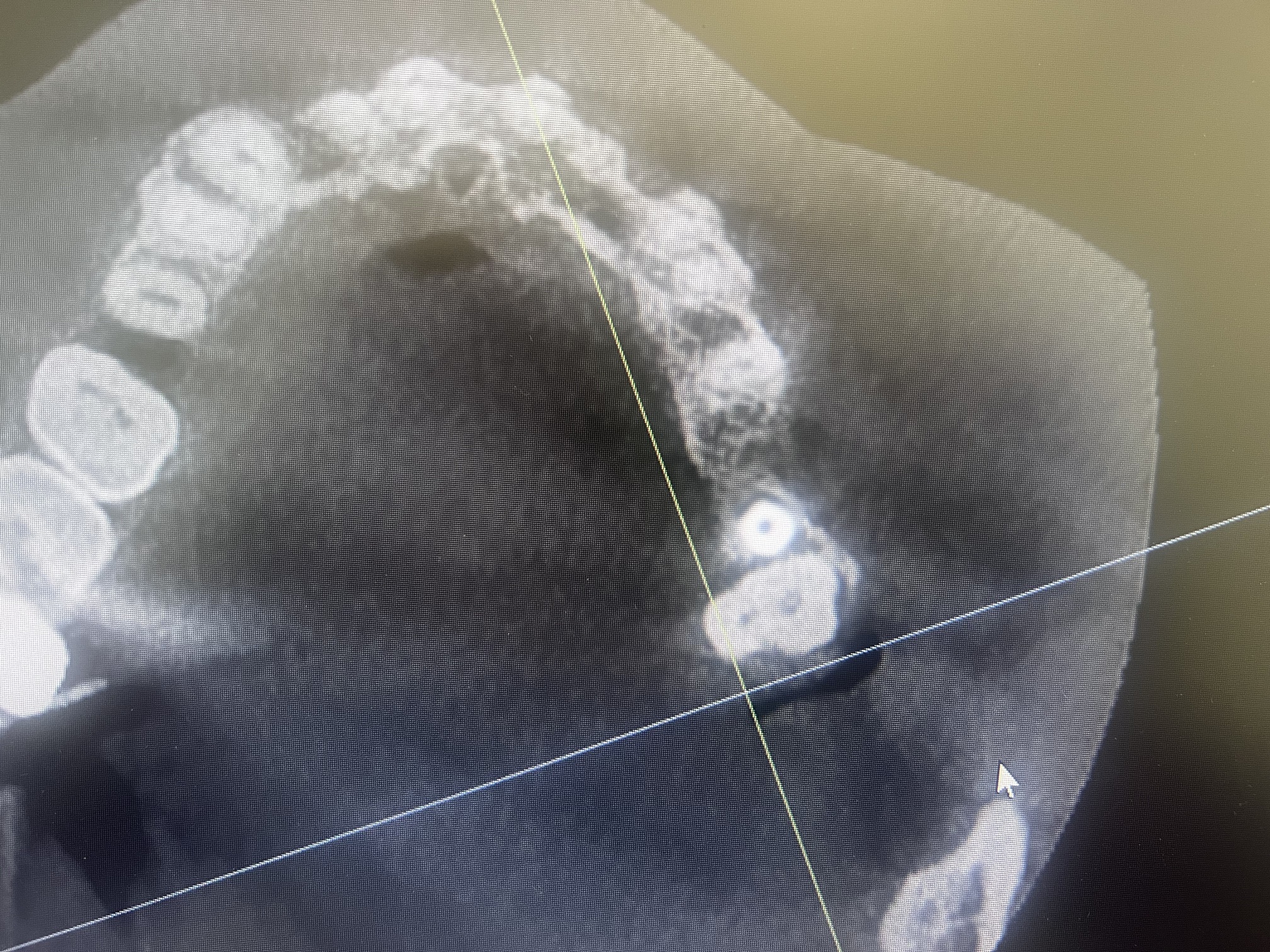 Implant placed too close to tooth