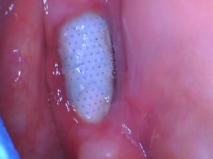 Exposed PTFE membrane on grafting site
