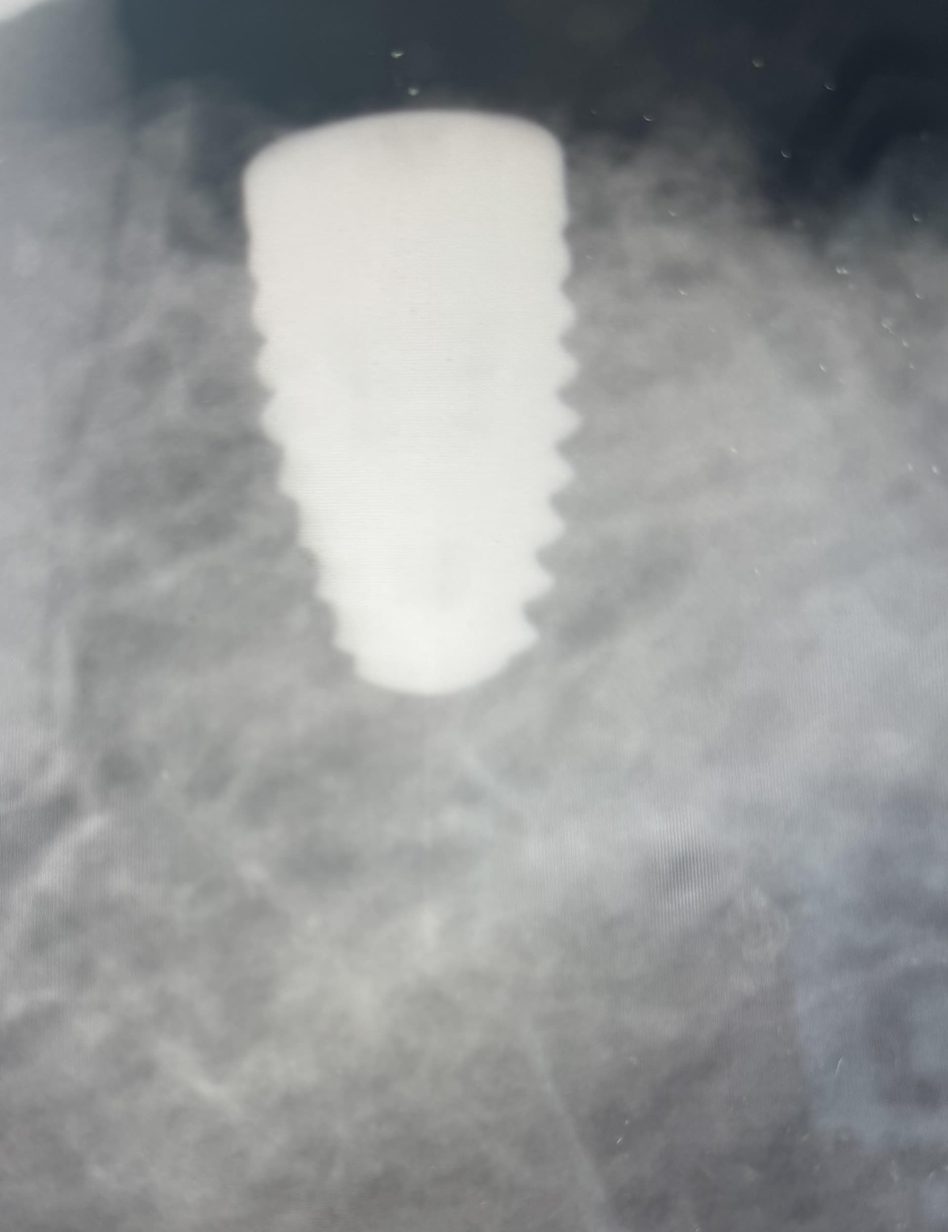 Implant long term success?