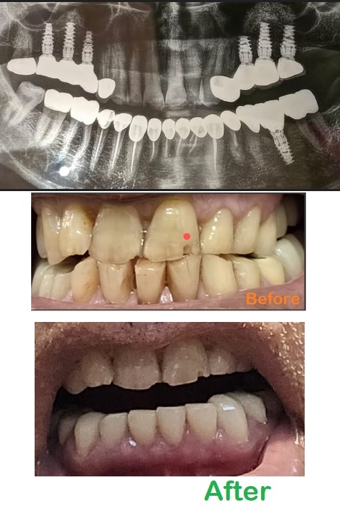 Gum inflammation post root canal treatment and crown placement