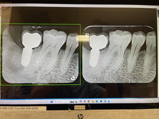 Implant failure