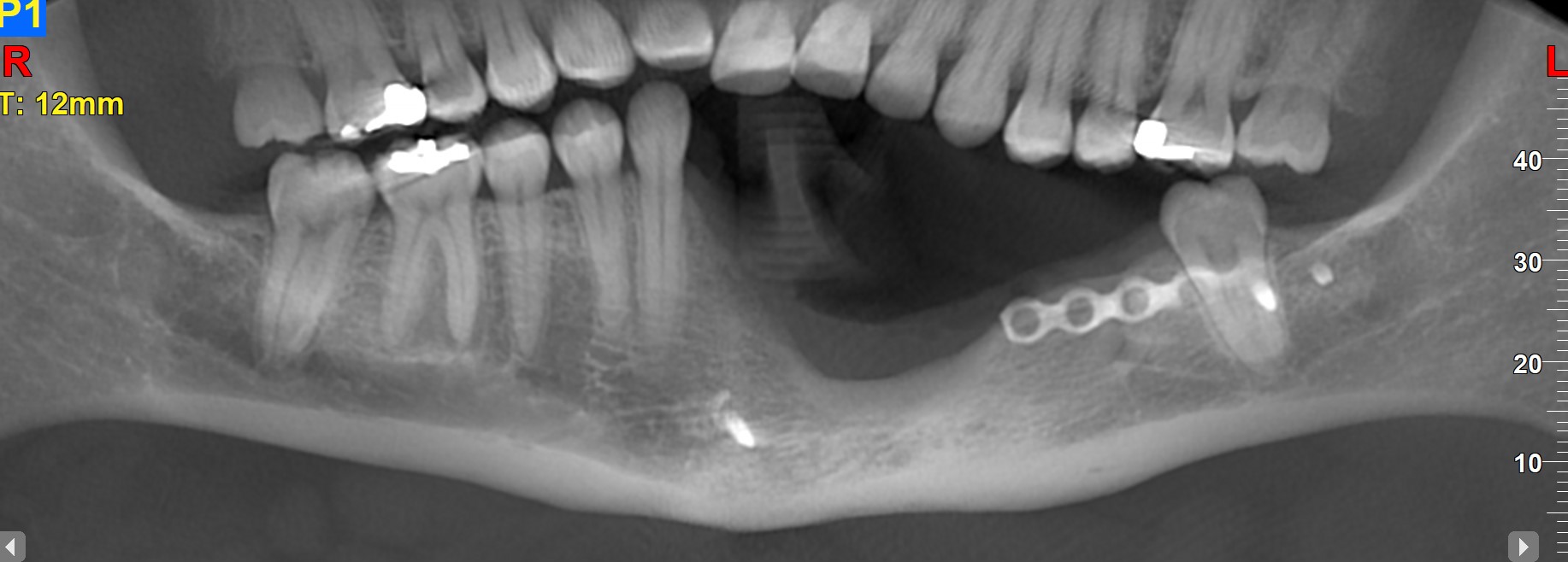 Challenging case of resected mandible s/p ameloblastoma