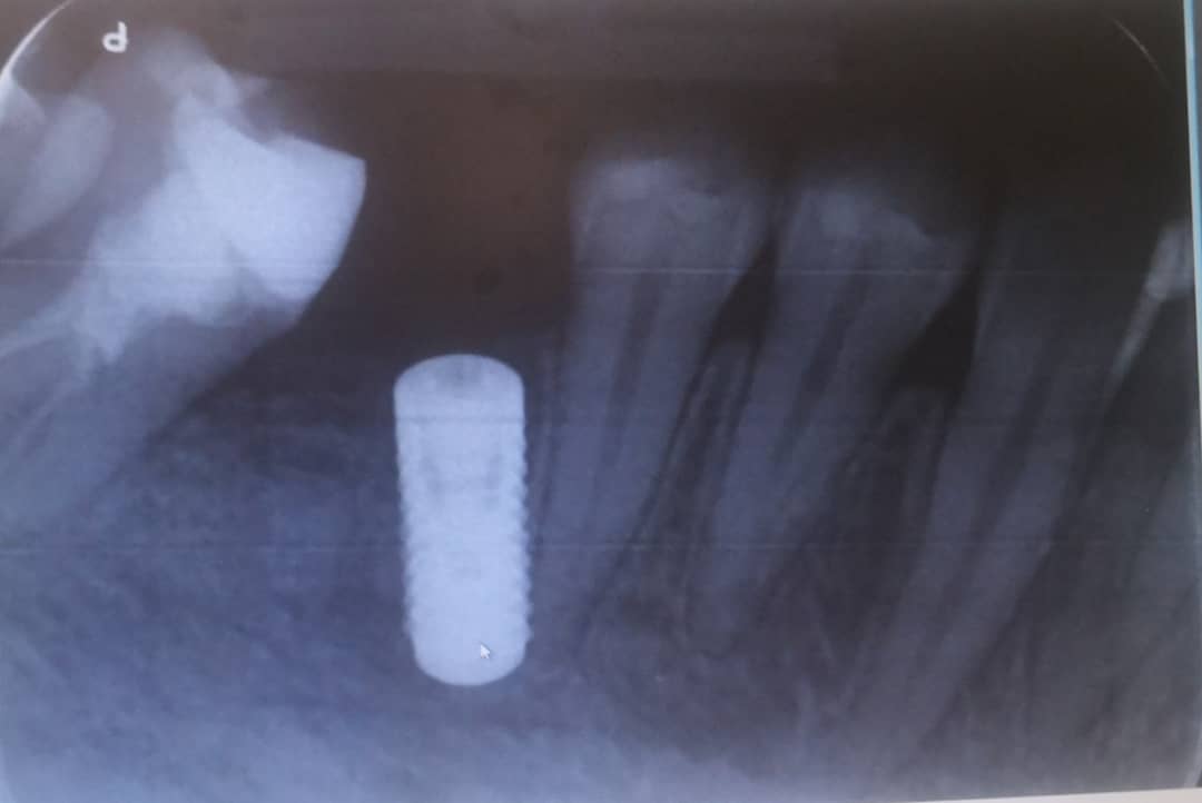 Implant angle (may too close to the adjacent tooth)