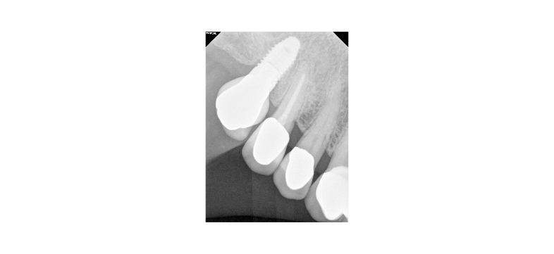 Could you please help me identify the implant?