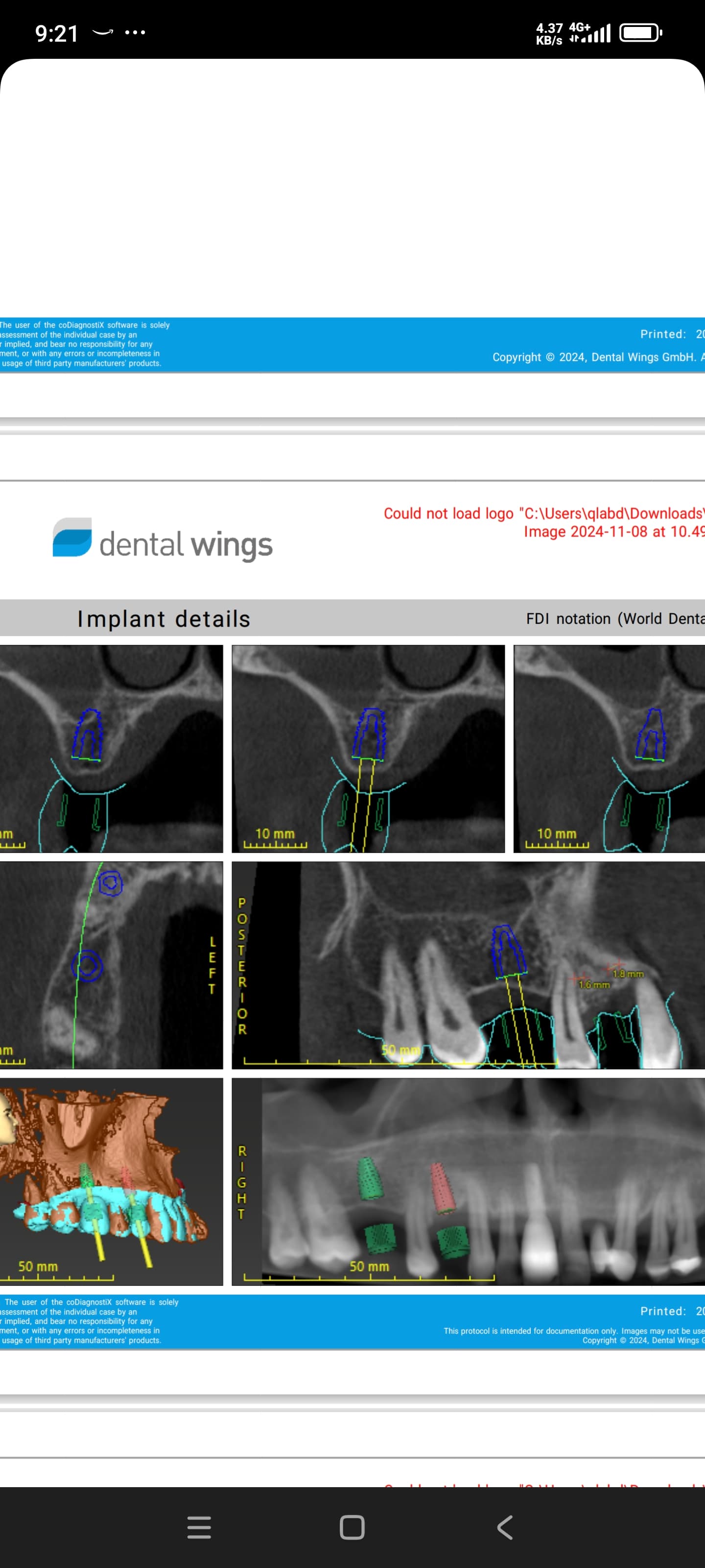 Possible internal sinus