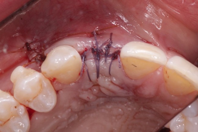 osseoseal-8