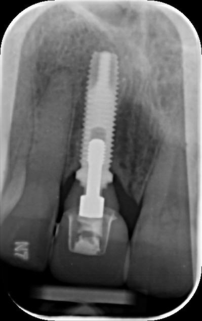 Help identifying implant placed 18 years ago