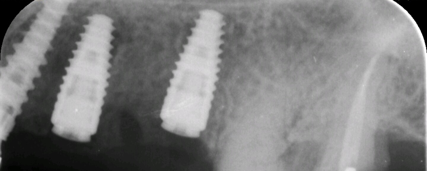 Mystery of implant apical radiolucency