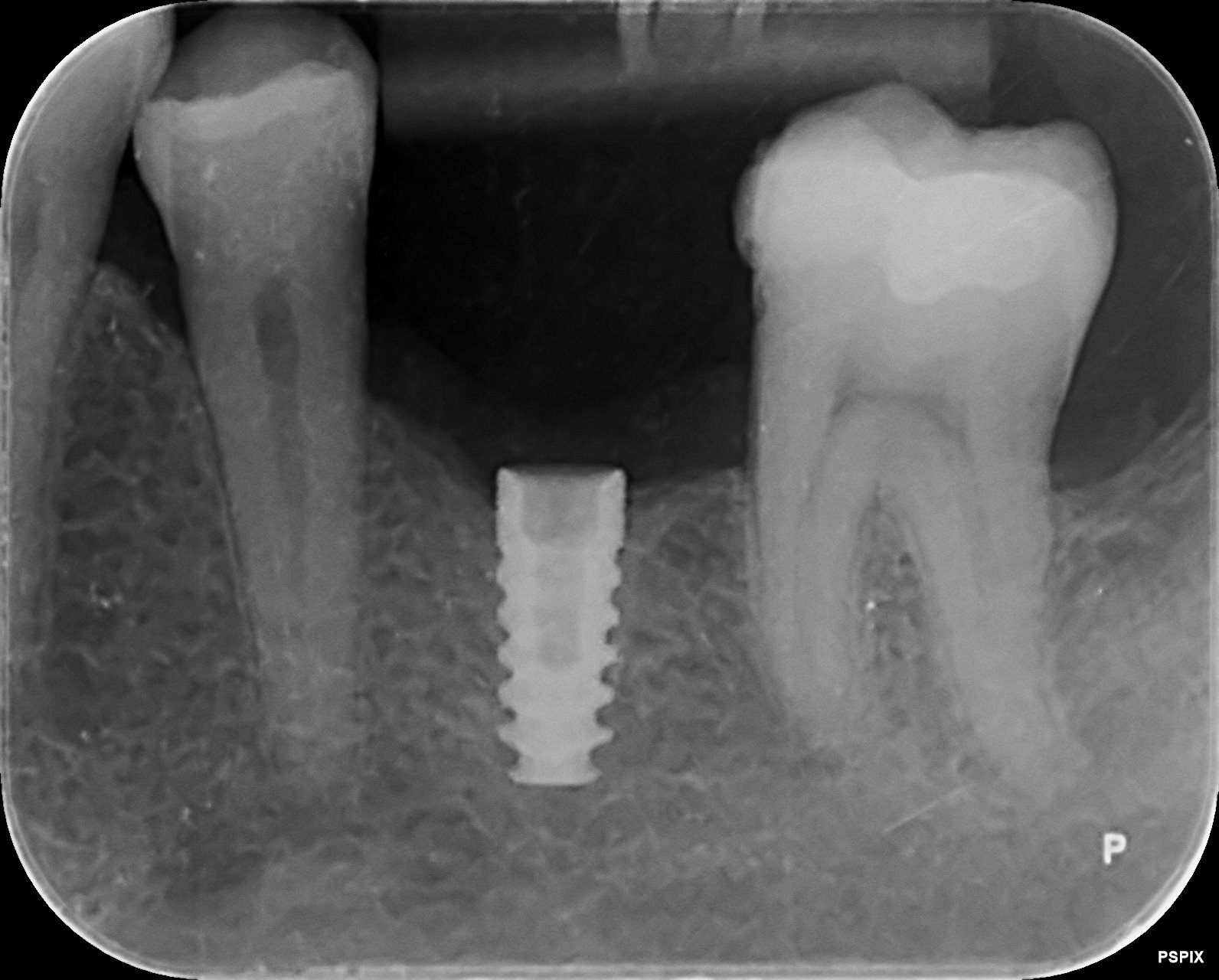 Identify implant type