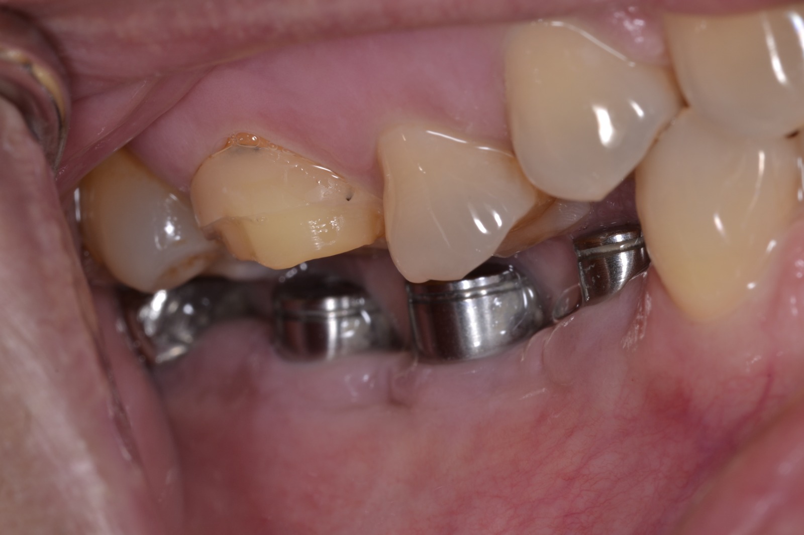 Low clearance options for mandibular implants