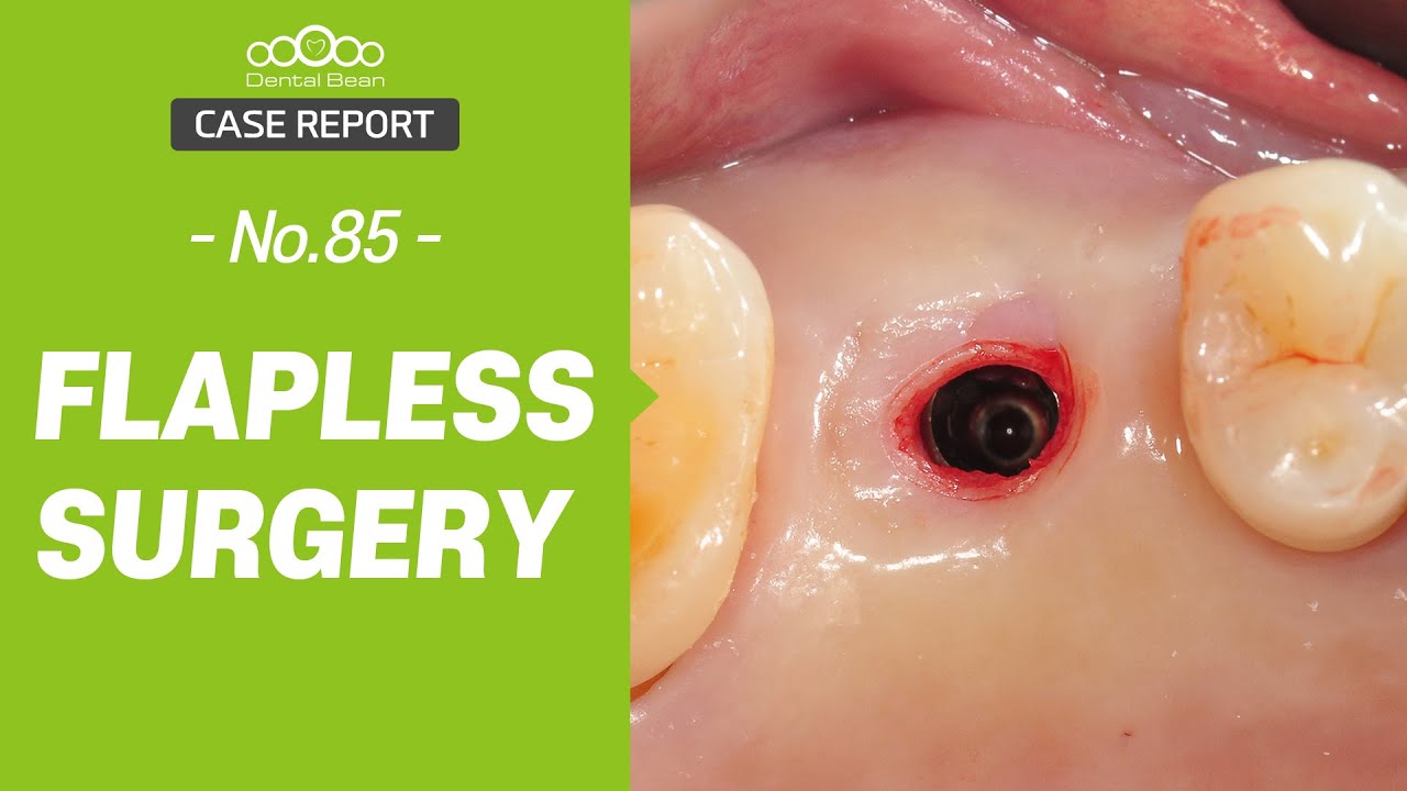 Flapless Implant Surgery in the Upper Posterior