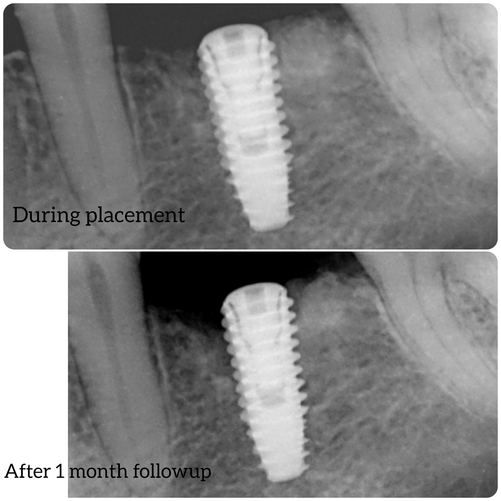 Bone loss around the Implant