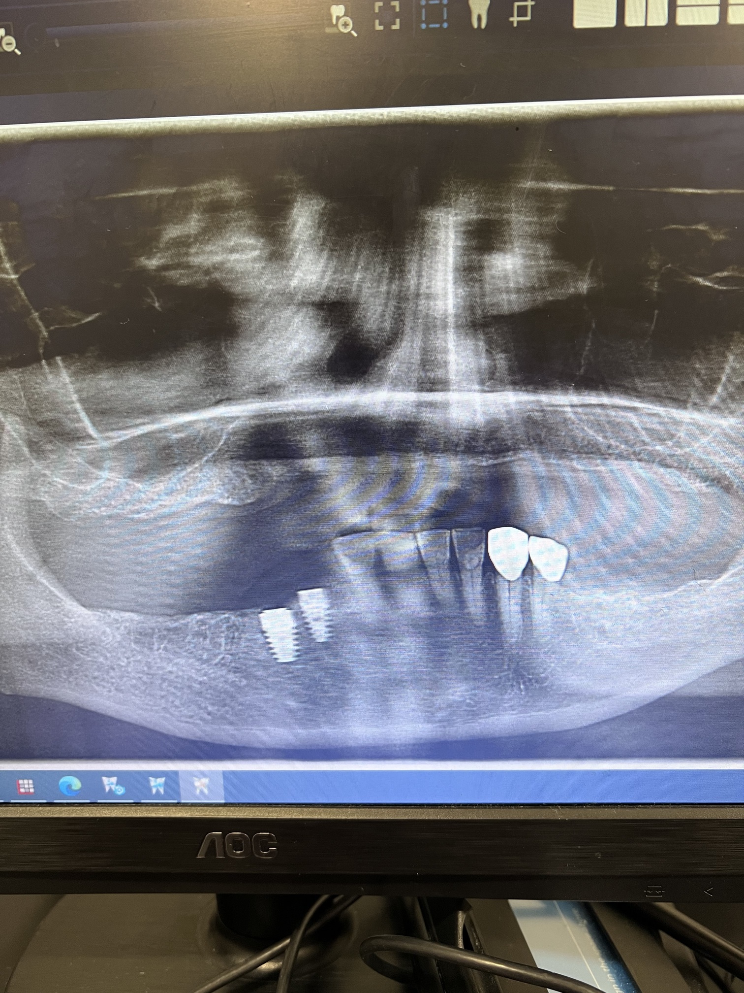 Thin buccal plate, no torque