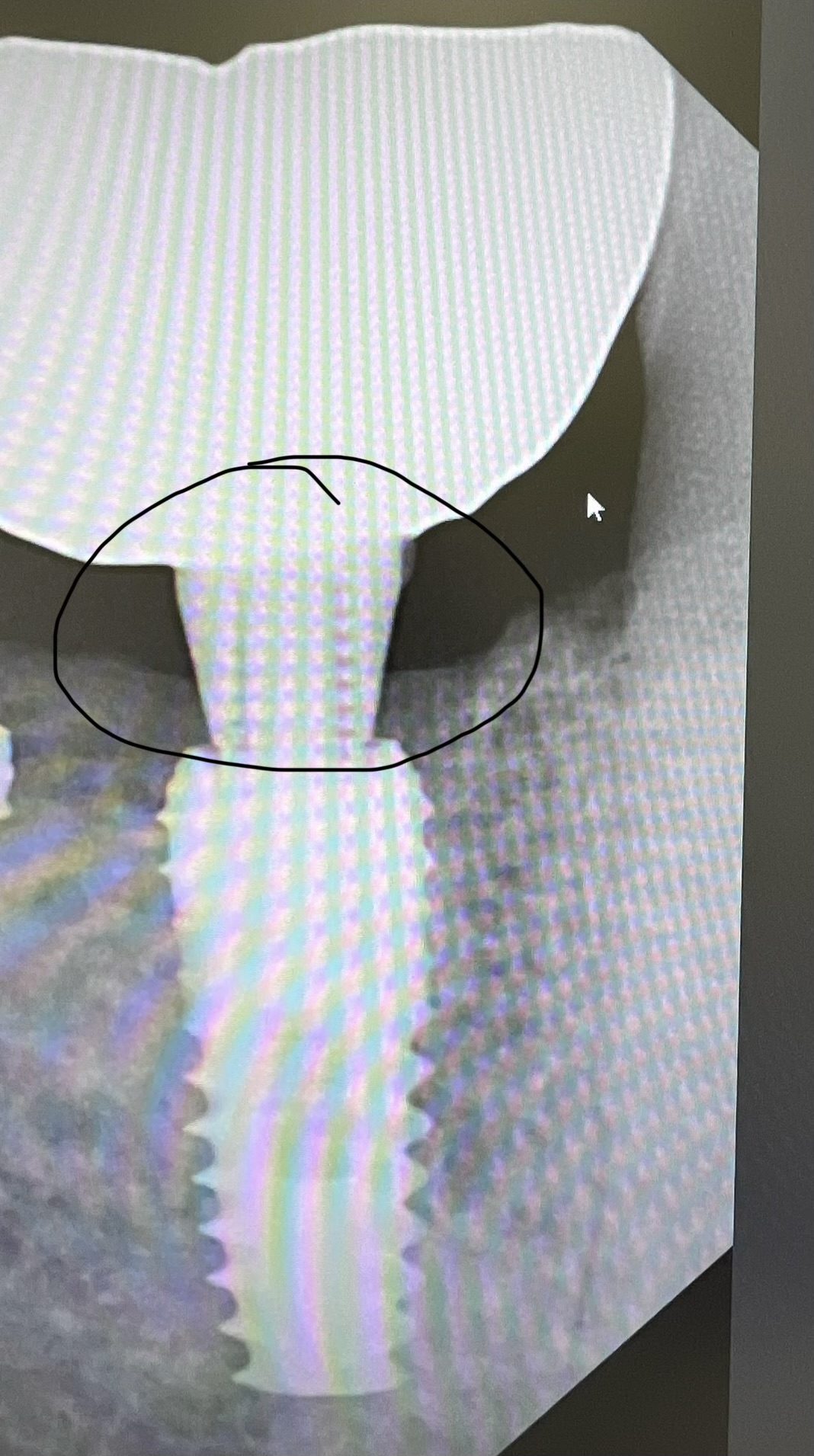 Could this encircled area because of too long healing abutment?