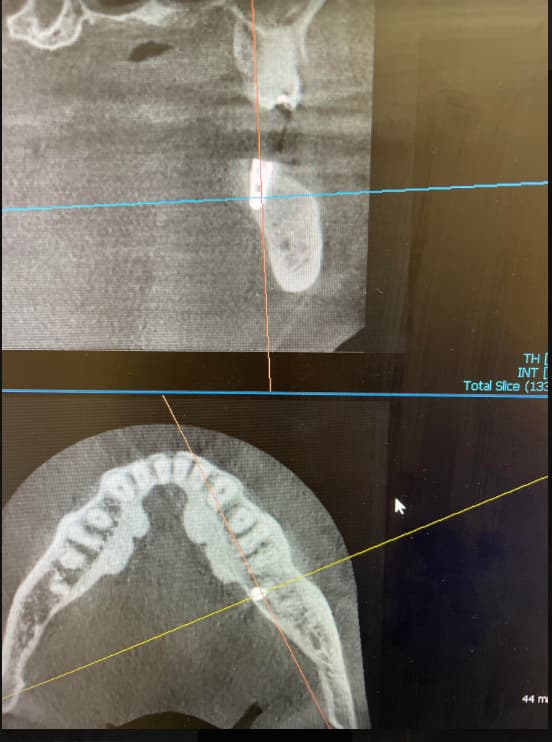 Possible lingual perforation after implant placement