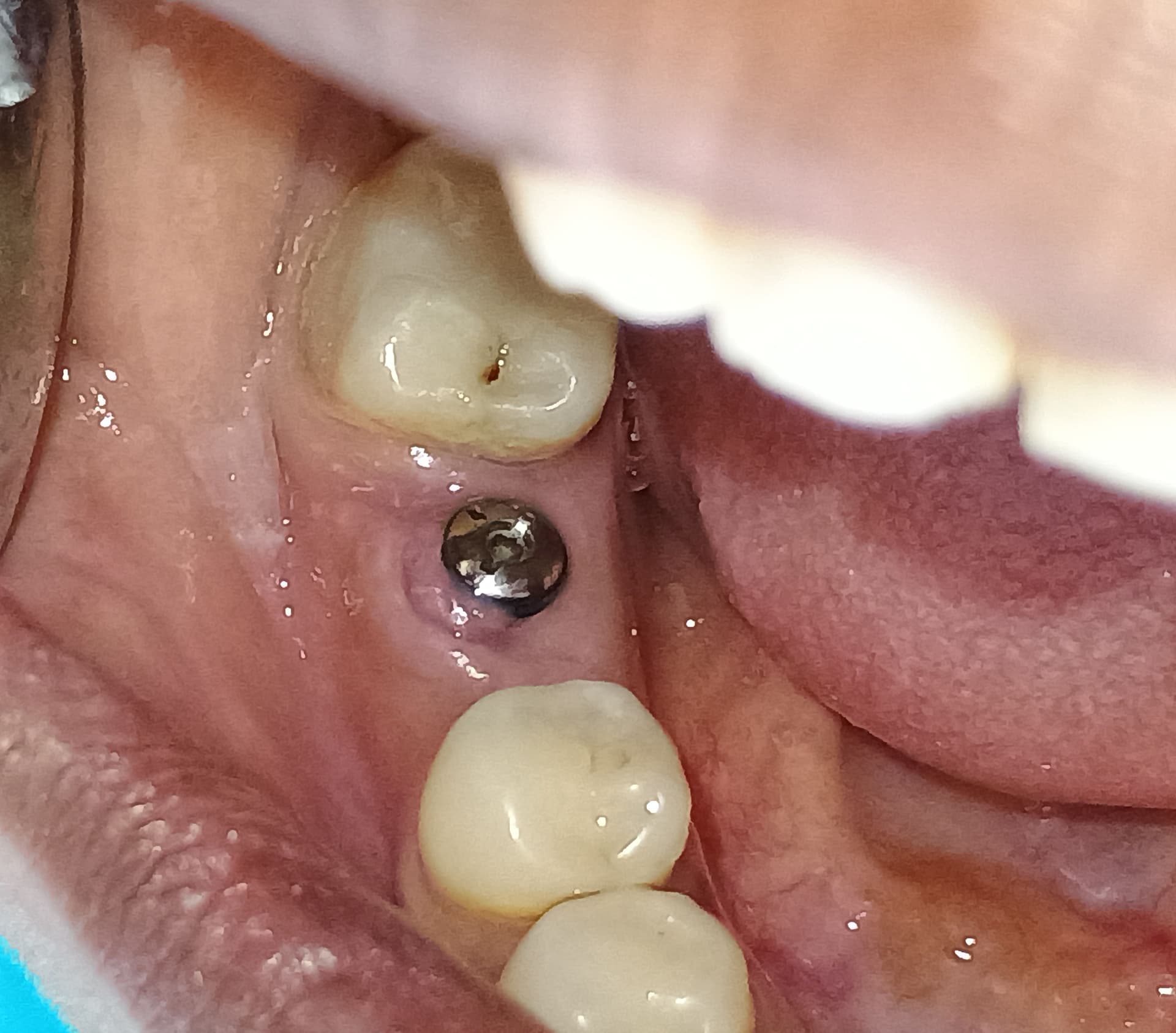 Gingival swelling around healing collar