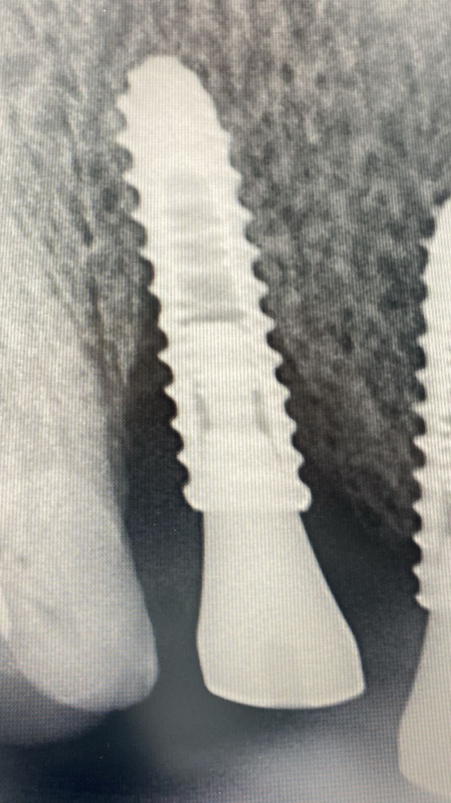 GBR for 15 or load without graft?