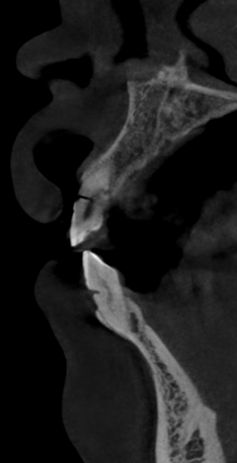 Tx planning for 3 upper anterior fractured teeth – Bridge or Singles?