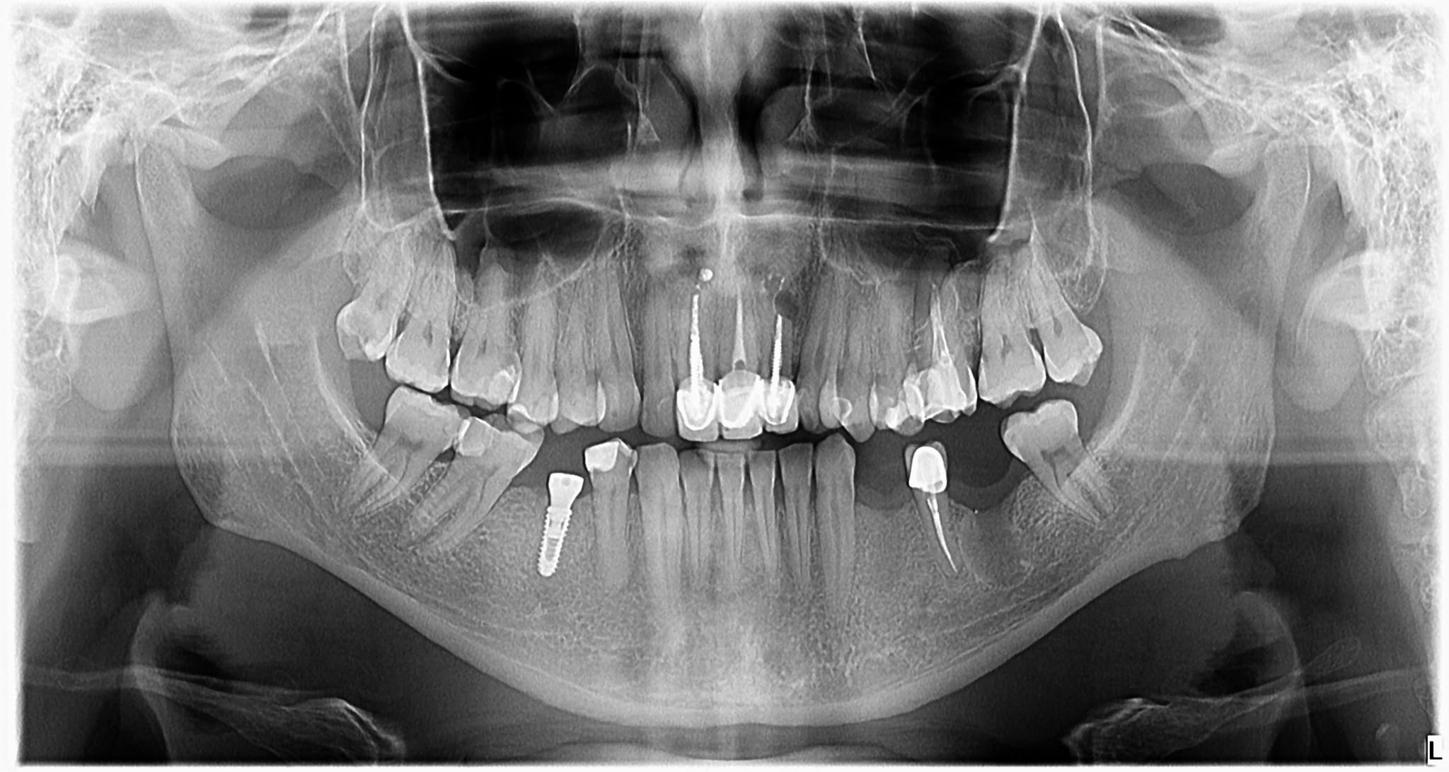 Will The Cyst Heal Cases And Questions OsseoNews