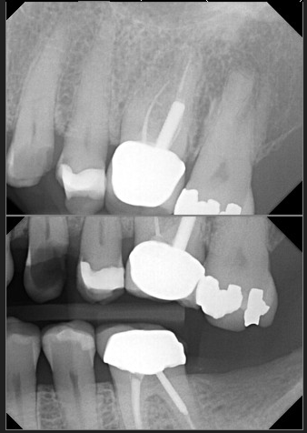Root canal and crown OR crown lengthening?